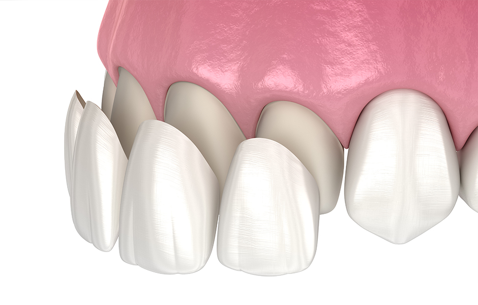 歯の表面に付けるセラミックで自信に満ちた口元を