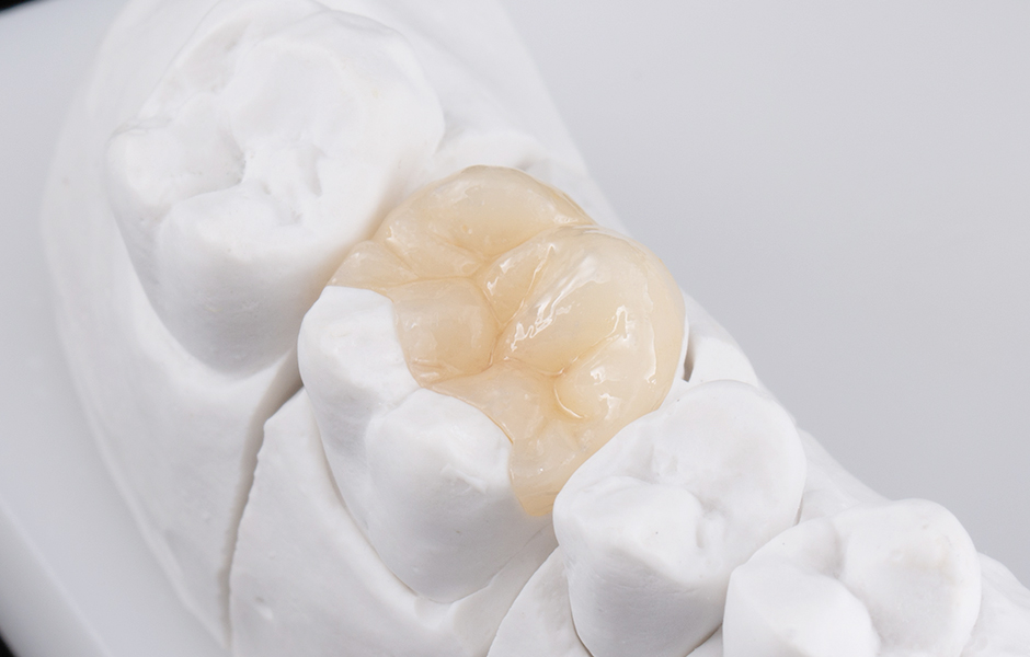 ノンメタル治療で見た目を美しく