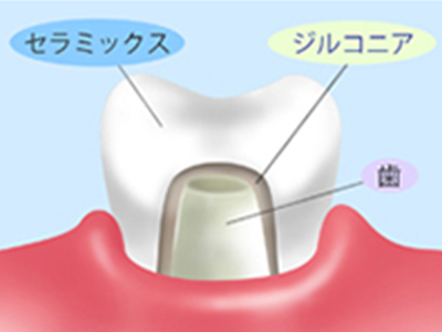 ジルコニアセラミック