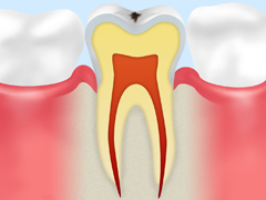 初期の虫歯（エナメル質の虫歯）