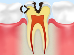 中期の虫歯（象牙質の虫歯）