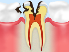 重度の虫歯（神経に達した虫歯）