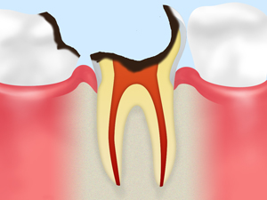 末期の虫歯（歯根に達した虫歯）