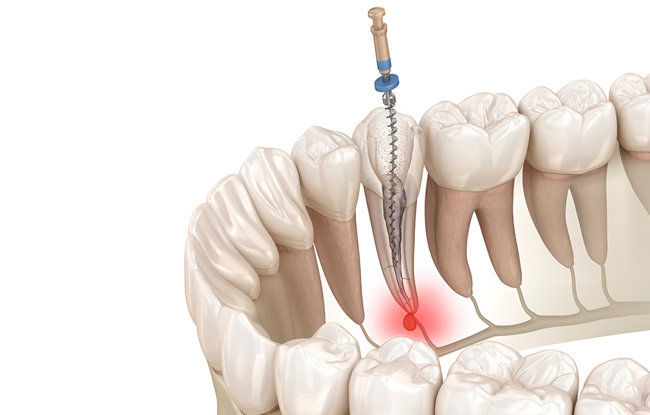 歯の神経まで虫歯が進行しても根管治療で歯を残せる可能性がある