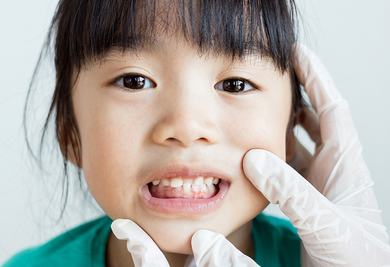 お子さまの矯正治療とお口の癖について