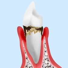 軽度歯周炎・中等度歯周炎
